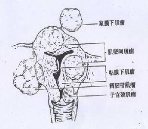 （圖）妊娠合併子宮肌瘤