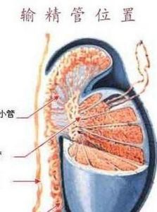 輸精管堵塞