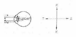 （圖）單純近視散光