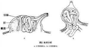 臍膨出