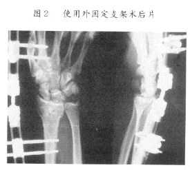 尺橈骨幹雙骨折