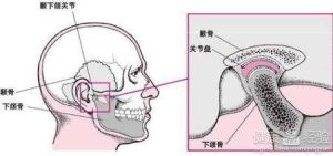 顳下頜關節內部紊亂