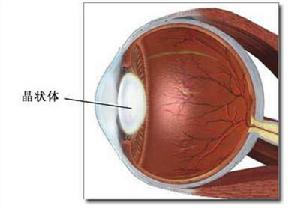 晶狀體溶解性青光眼