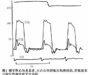 慢性縮窄性心包炎