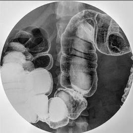結腸雙對比造影