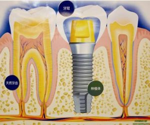 牙種植體
