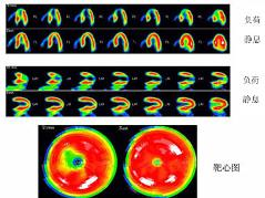 心肌灌注顯像