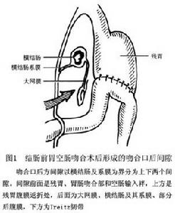 胃切除術後內疝