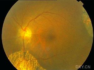 （圖）色素性靜脈旁視網膜脈絡膜萎縮 