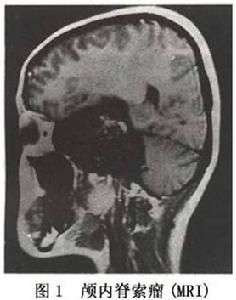 圖1 腦內脊索瘤