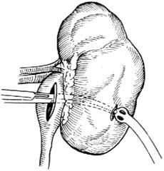 經皮腎盂造瘺術