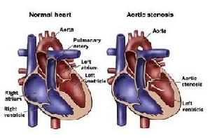 先天性主動脈瓣狹窄