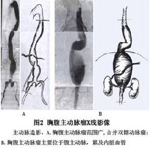 （圖）胸腹主動脈動脈瘤