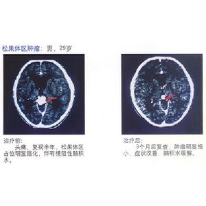 神經系統副腫瘤綜合徵