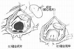 繼發性心房間隔缺損