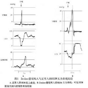 環咽肌失弛緩症