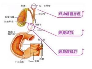 膽囊囊腫