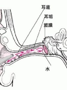 中耳炎