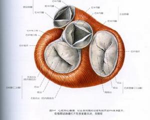 風濕性二尖瓣狹窄