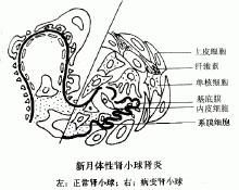 新月體性腎小球腎炎 