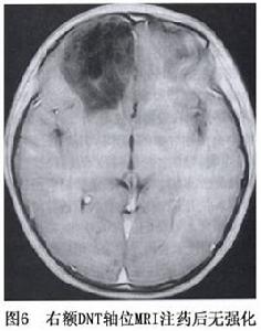 神經元腫瘤和神經元與神經膠質混合性腫瘤