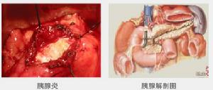 急性出血壞死型胰腺炎