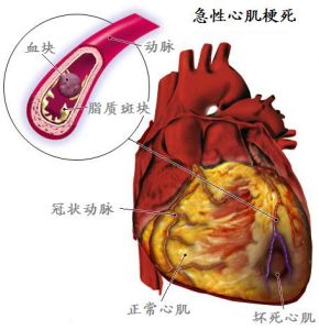 心肌梗死