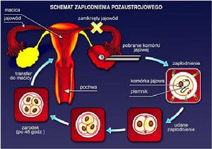 IVF-ET