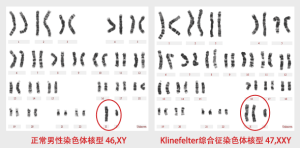 Klinefelter氏綜合症