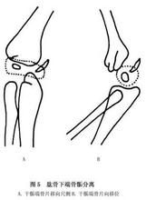 肱骨遠端全骺分離