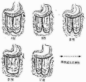 血栓閉塞性脈管炎