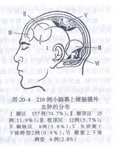 硬腦膜外血腫