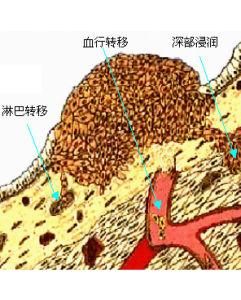 皮膚腫瘤