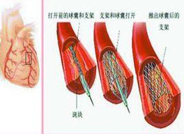 心臟介入治療