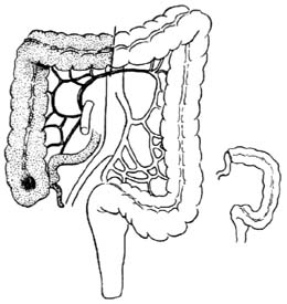 《結腸部分切除術》