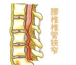 腰椎管狹窄