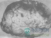 小兒柞蠶蛹性腦病綜合徵