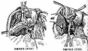 結石性膽囊炎