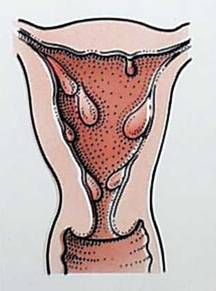 卵巢功能缺如綜合徵