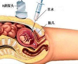 羊水穿刺檢查