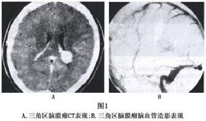 腦室內腦膜瘤