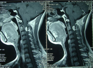 頸髓內腫瘤