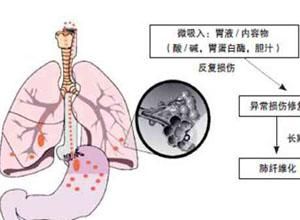 吸入性損傷