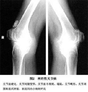 神經源性關節病