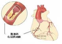 急性系支氣管炎