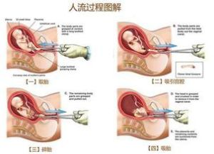 人工流產手術