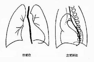 冠狀動脈心腔瘺