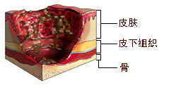 壞死潰瘍期