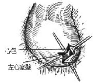 心包切開術后綜合征