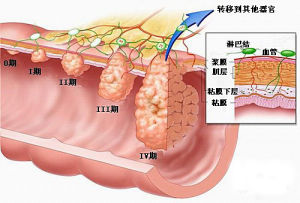 腸直腸癌